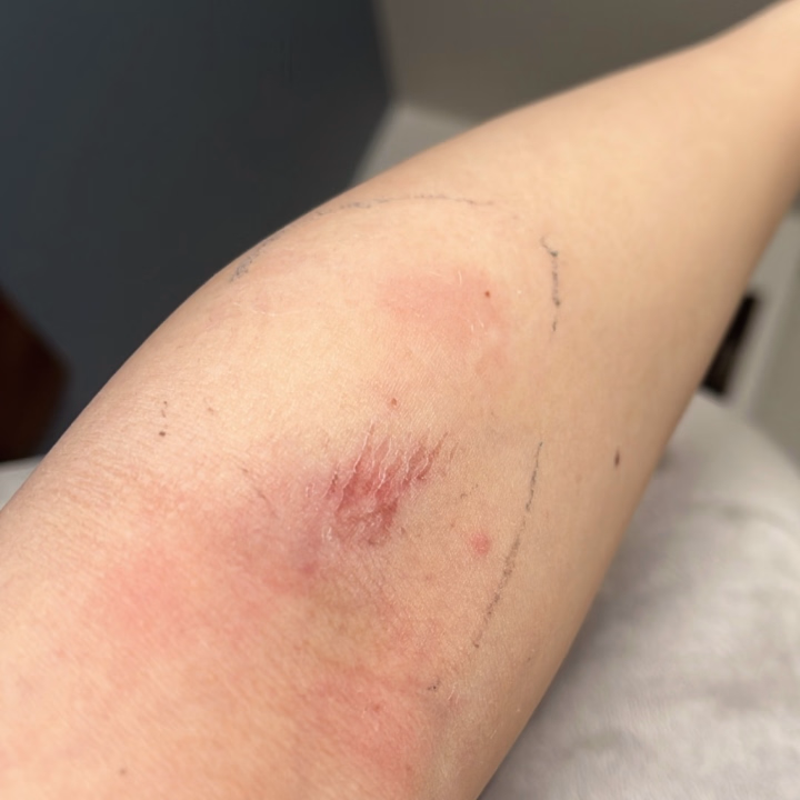 ストレス性胃腸炎つきひだよ！

病院に運ばれた時に脱水症状起こしてたから、点滴をして貰ったんだけど

私の血管が細かったのか、なかなか針が入らなかったみたいでこんな事に

そして未だに完全復活出来ておらず、

やっとこさ、にゅうめんを食べられるようになったところでございます。

それまでは、ゼリーとOS1、梅干し、お味噌汁しか食べられていなかったから

低血糖の症状で手が震えるしめまいするし、調子乗って動いたら気持ち悪くなるし…

到底えろなんて出来ないので、明日お休みします。

すみません。

30日は出勤したい所ですが、皆様が求めているような激しいプレイは出来ません。